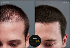 Crown Twenty1 fibers applied to thinning roots for fast, seamless coverage.