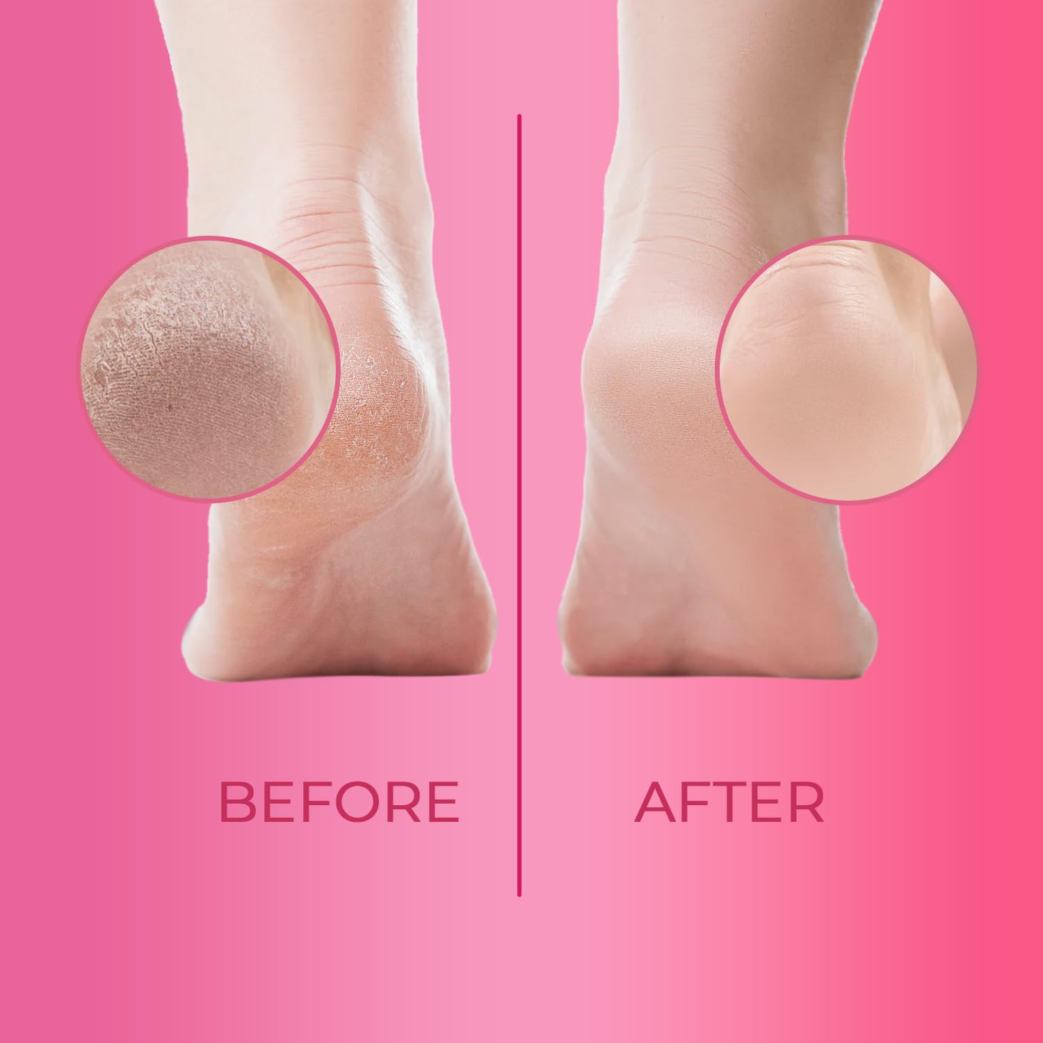 Applying Cutikles callus remover gel to rough heel areas to soften texture.