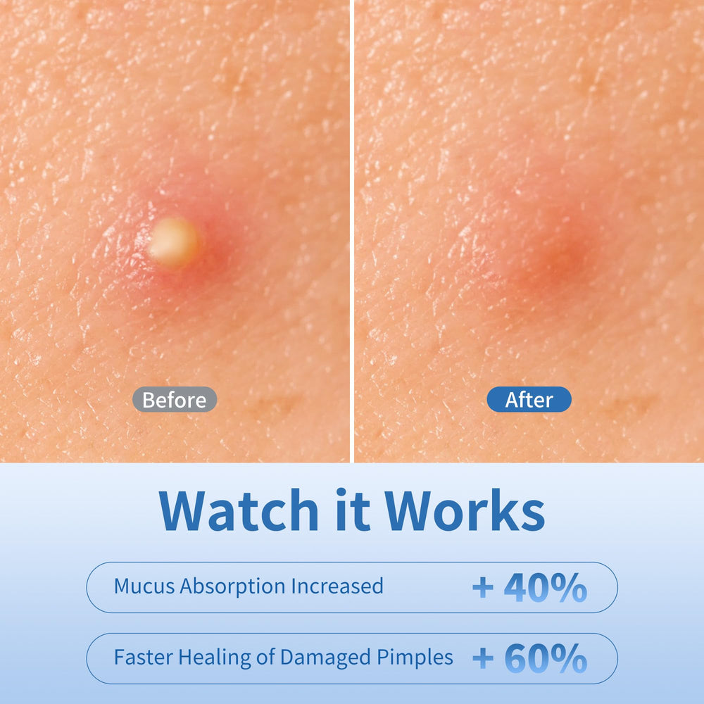 Daolyo 14mm patches protect larger breakouts overnight.