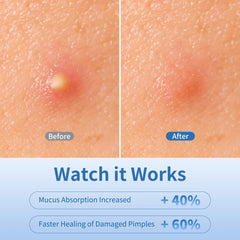 Daolyo 14mm patches protect larger breakouts overnight.