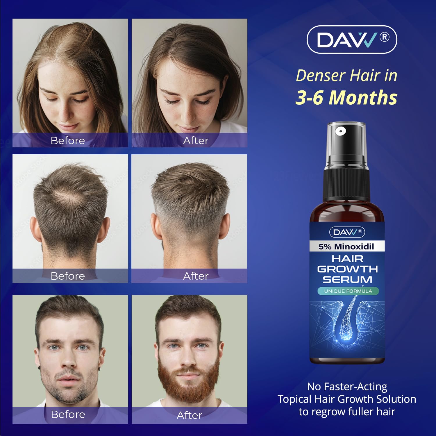DAVV Minoxidil spray applied to scalp for quick absorption