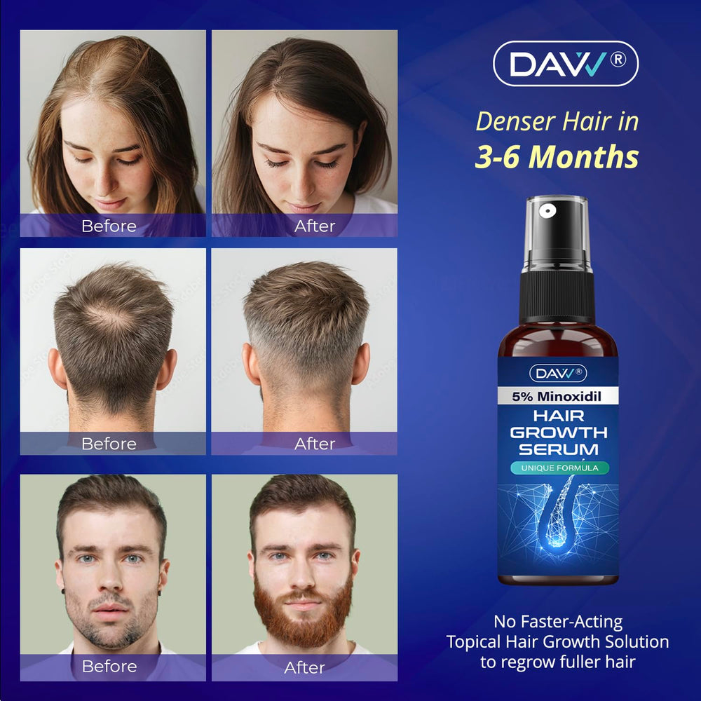 DAVV Minoxidil spray applied to scalp for quick absorption