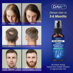 DAVV Minoxidil spray applied to scalp for quick absorption