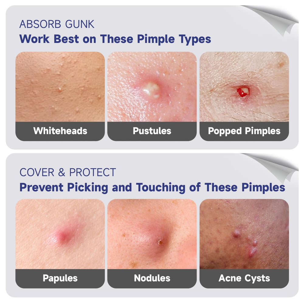 Dazzlook moon patch spot treats breakouts with gentle adhesion.