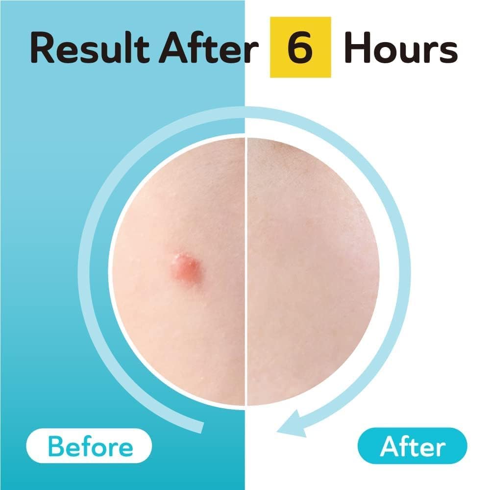 DERMA ANGEL 12mm patches blend with skin tone for discreet wear.