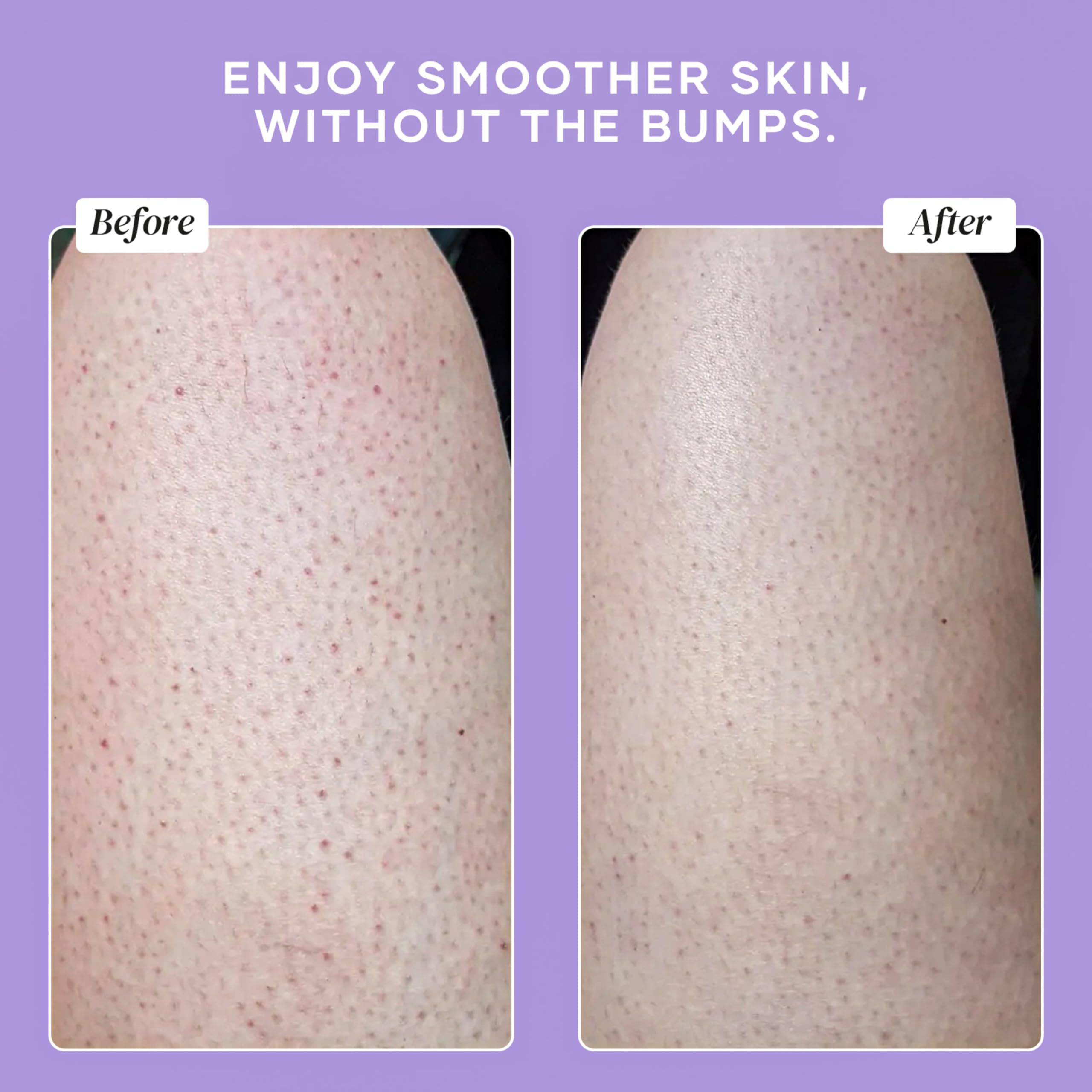 DERMAdoctor KP Bump Eraser lather forms in shower for skin prep.