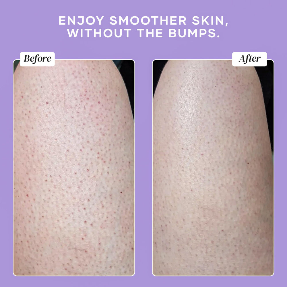DERMAdoctor KP Bump Eraser lather forms in shower for skin prep.
