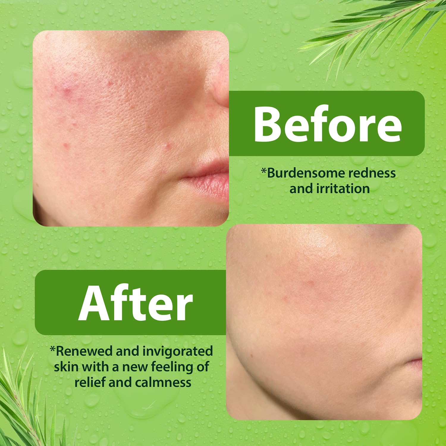 Derma-Nu model applying cleanser for daily use on acne-prone skin.