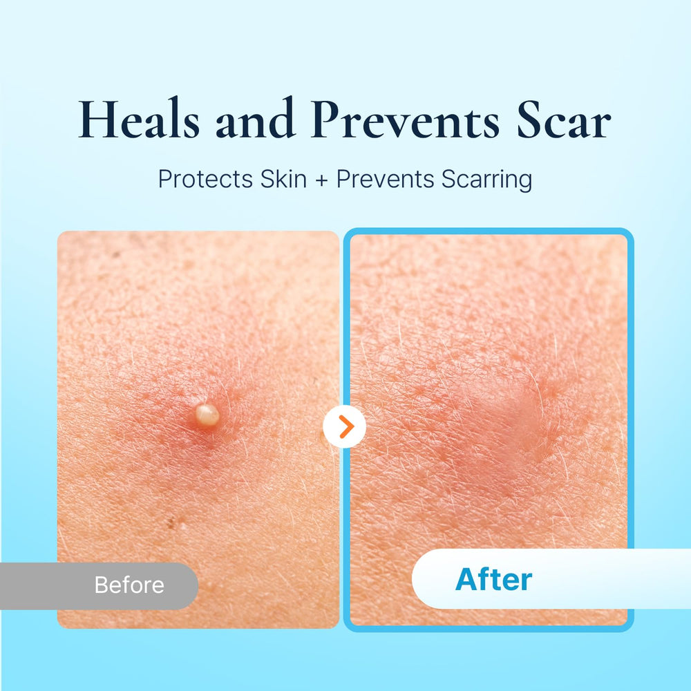 DERMAKR ultra-thin pimple patch remains barely noticeable while working on blemishes