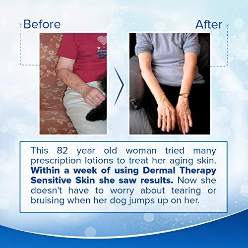 Dermal Therapy 15-percent allantoin ingredient close-up highlights soothing skin support.