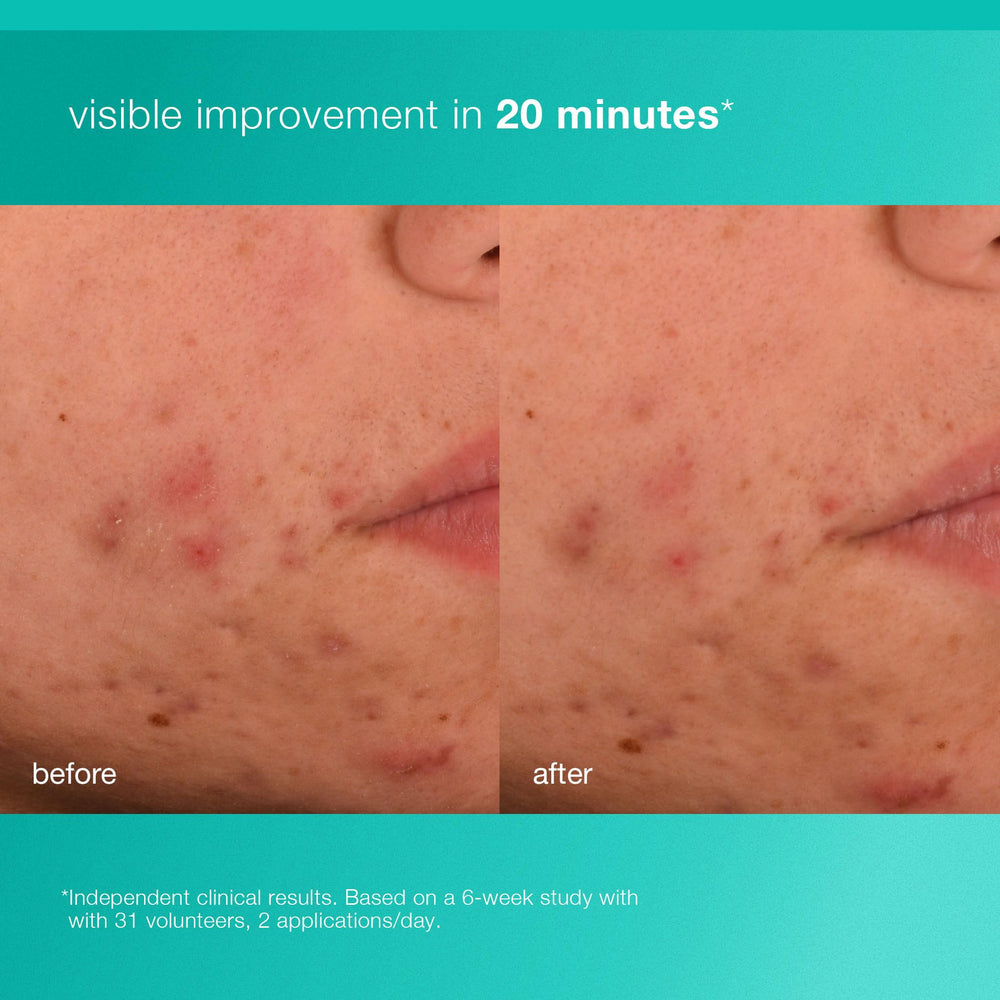 Dermalogica Acne Biotic features Bioengineered Plankton Extract soothing the skin barrier.