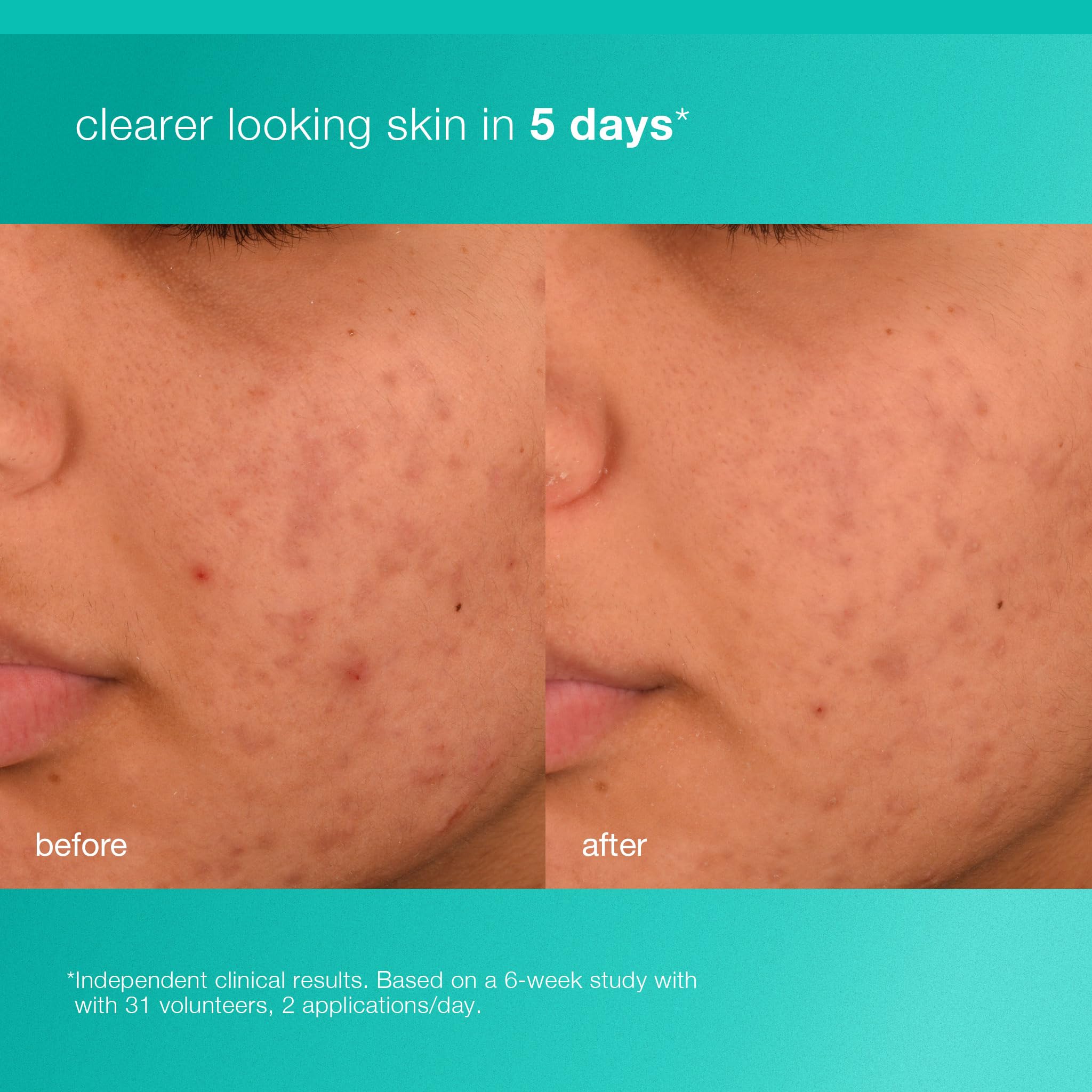 Dermalogica Acne Biotic with 0.5% Salicylic Acid targets breakouts and pores.