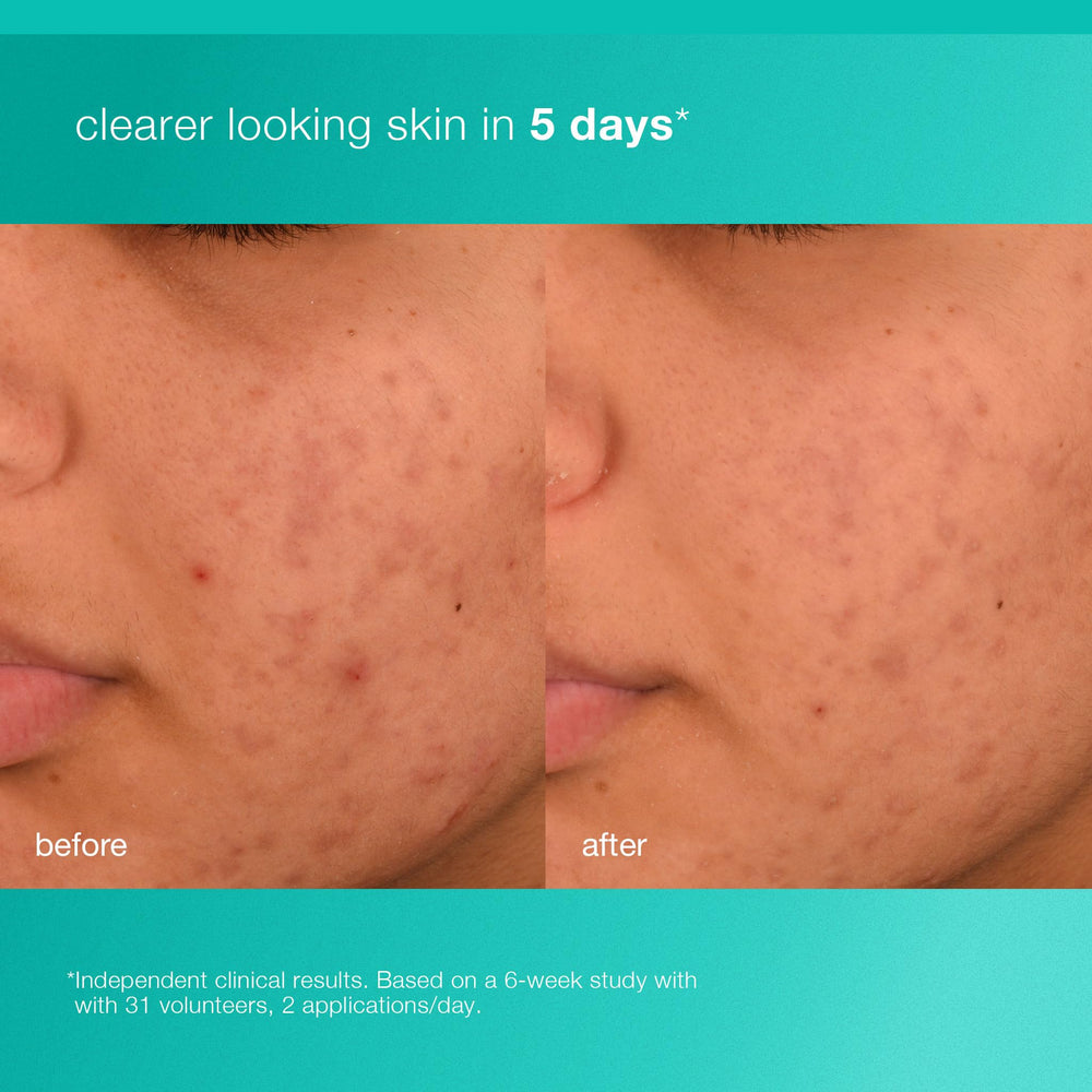 Dermalogica Acne Biotic with 0.5% Salicylic Acid targets breakouts and pores.