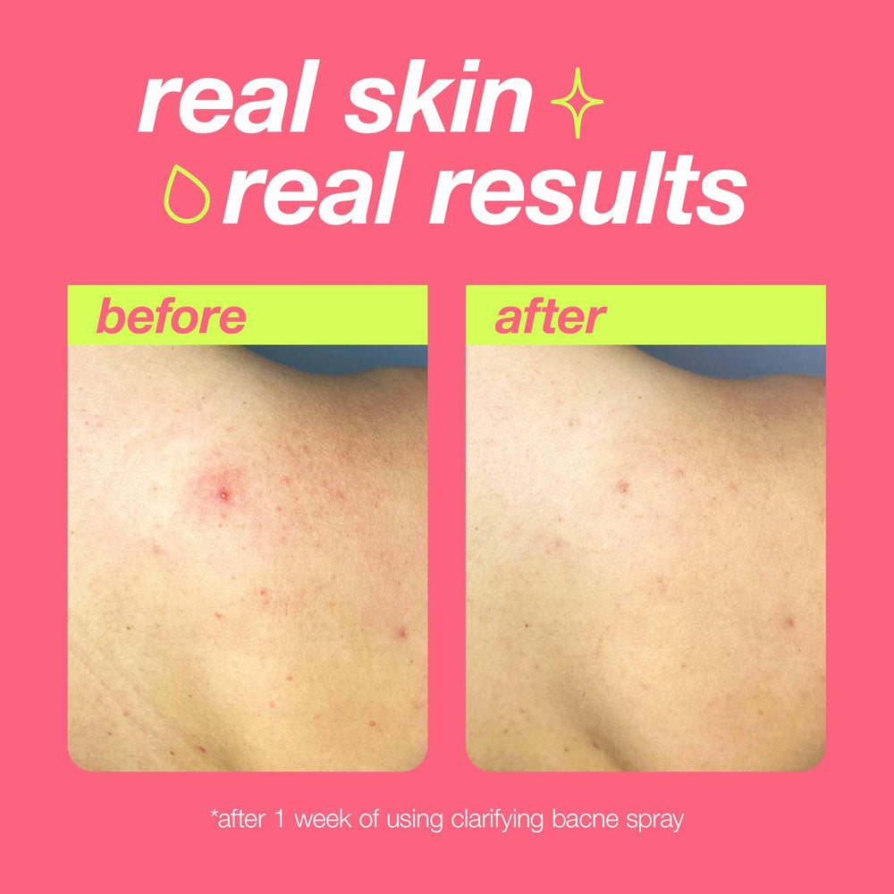 Dermalogica Clear Start Bacne Spray close-up of salicylic acid exfoliating pores.