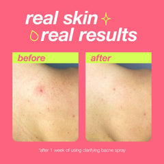 Dermalogica Clear Start Bacne Spray close-up of salicylic acid exfoliating pores.