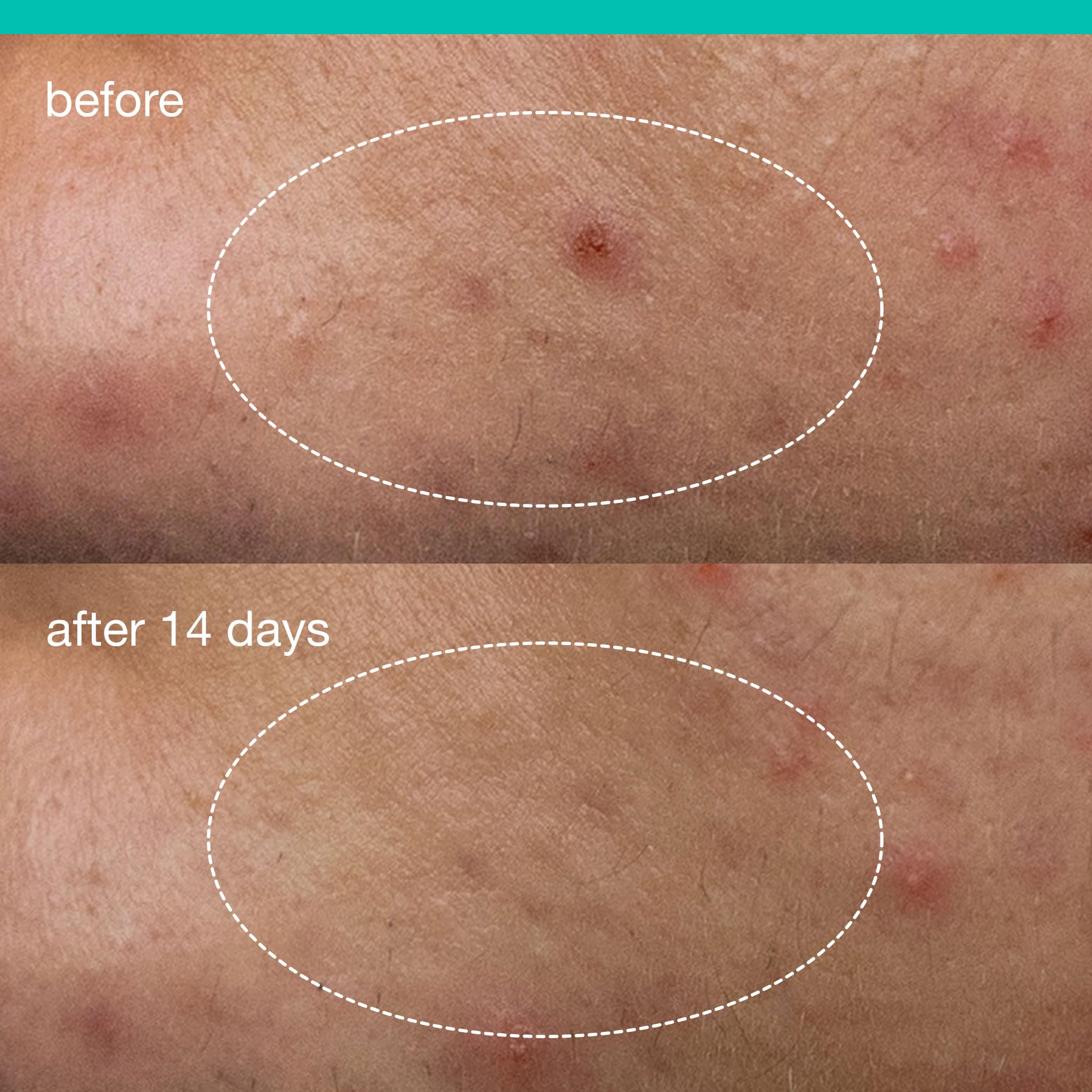 Dermalogica Deep Acne Liquid Patch featuring pomegranate extract to refine skin