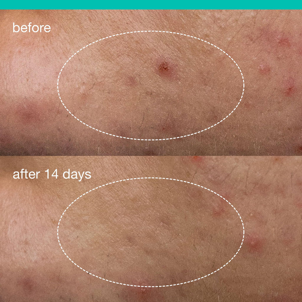 Dermalogica Deep Acne Liquid Patch featuring pomegranate extract to refine skin