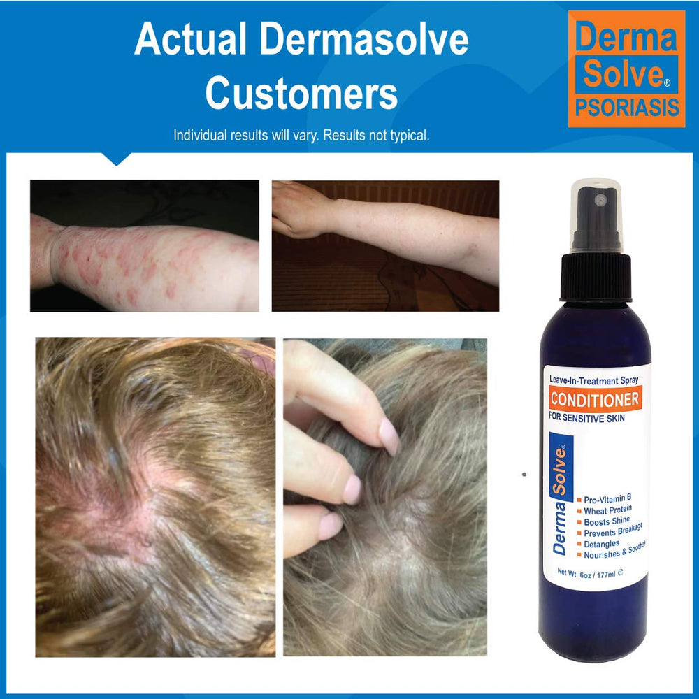 Dermasolve psoriasis fragrance-free bottle emphasizes gentle formula for sensitive scalps.
