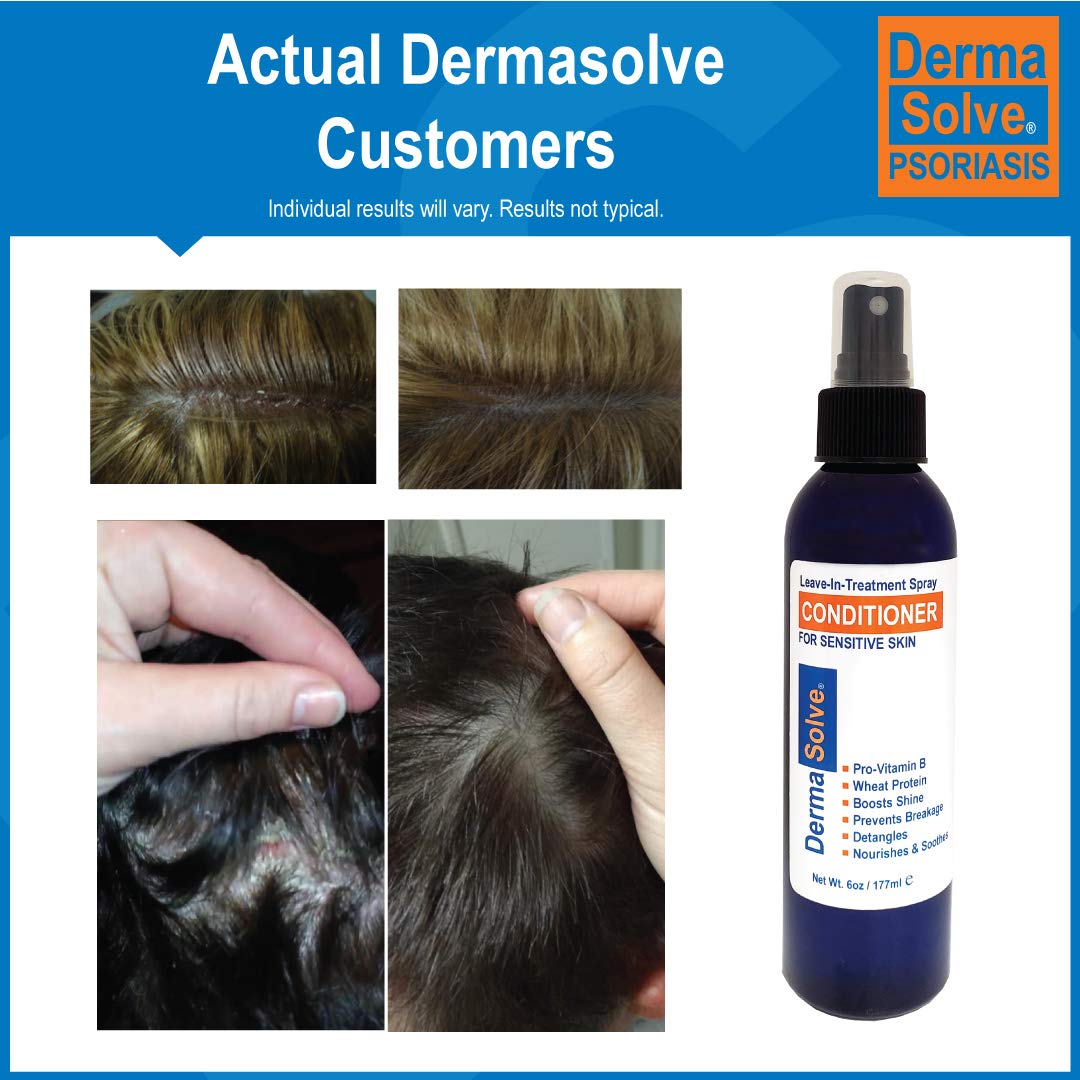 Dermasolve psoriasis scalp hydration close-up demonstrating soothing herbal extracts benefit.