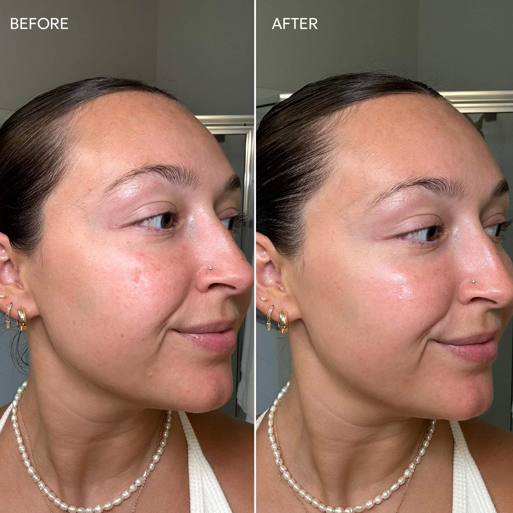 Applying Dermisa cream on the skin showing gentle touch