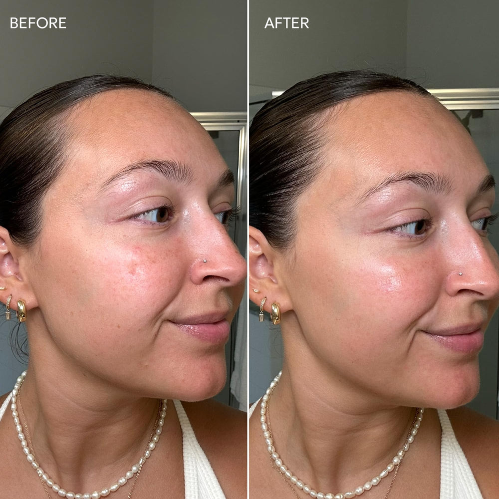 Applying Dermisa cream on the skin showing gentle touch