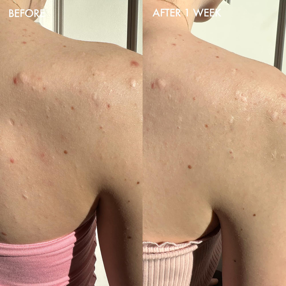 Dermisa sulfur bar with aloe vera pores close-up showing potential unclogging benefits