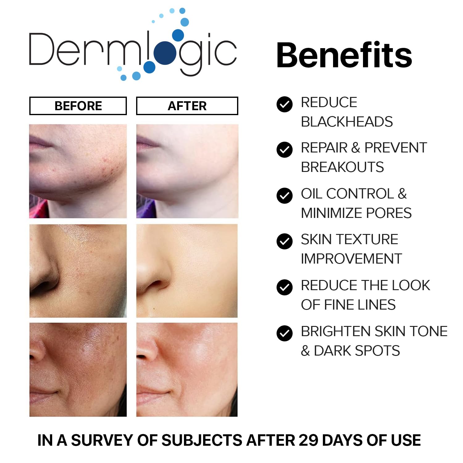 Dermlogic acne pads being applied to skin for cleansing and oil management