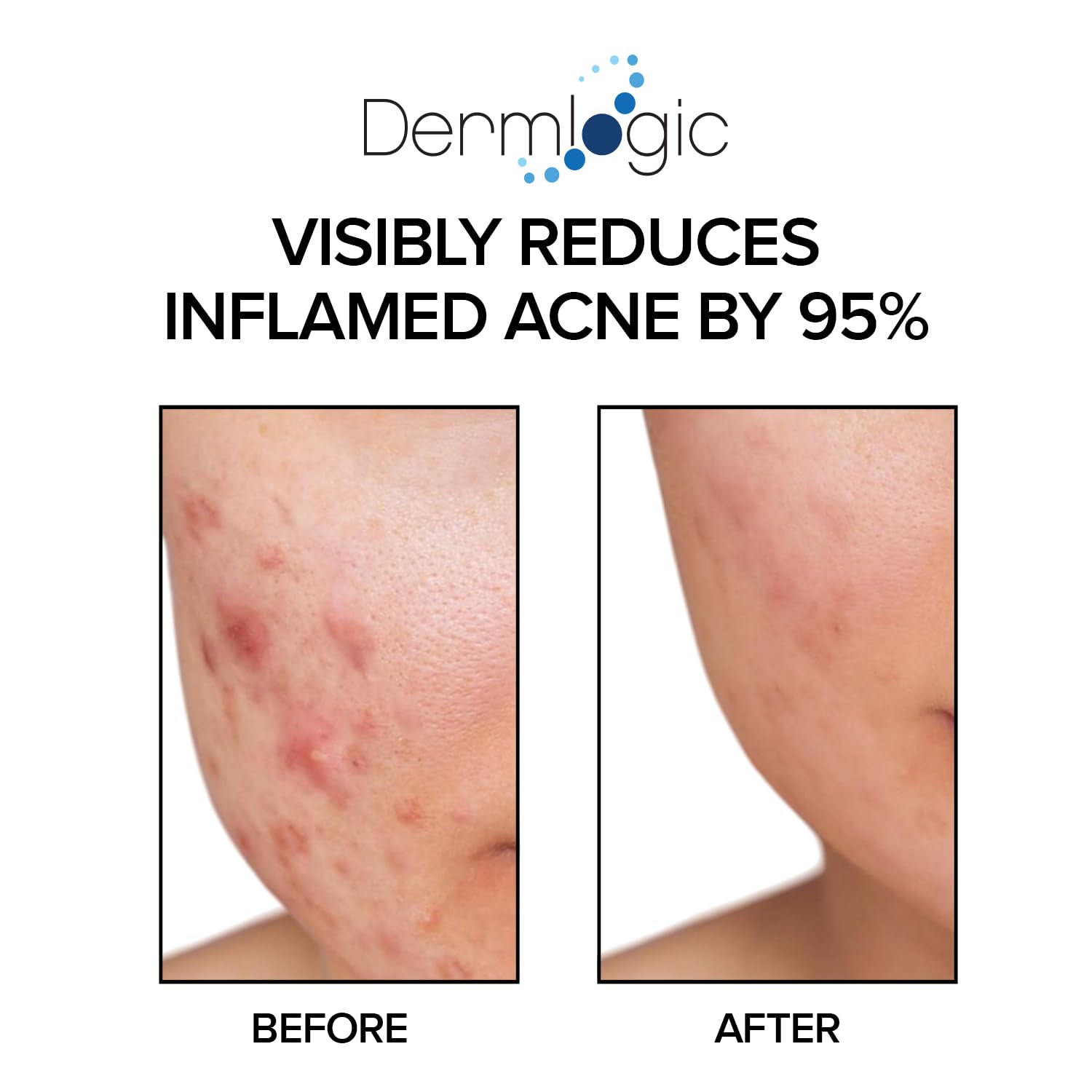 Dermlogic acne pads with green tea and aloe ingredients for soothing hydration
