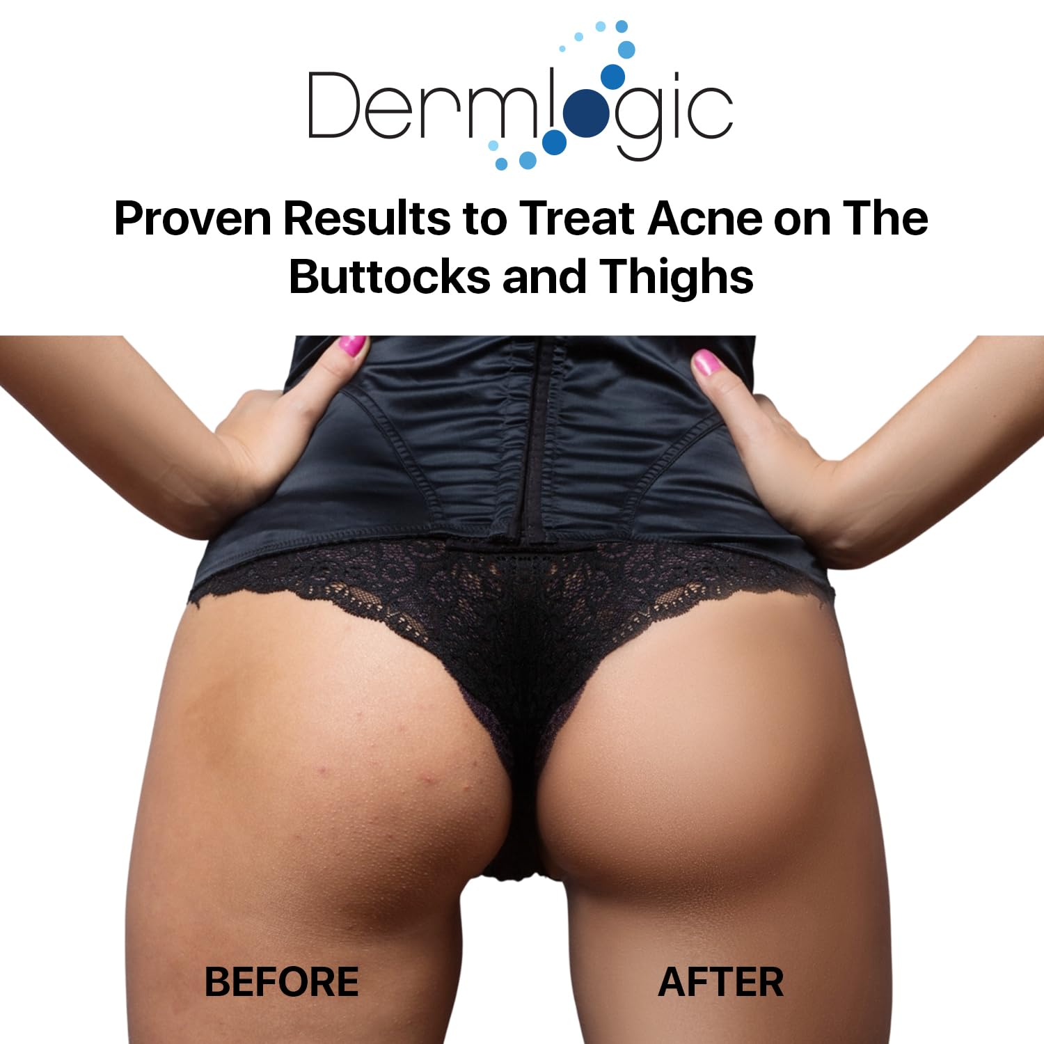 Dermlogic butt-thigh acne treatment creamy texture for easy spread