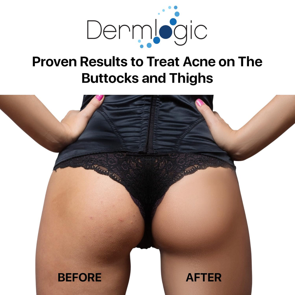 Dermlogic butt-thigh acne treatment creamy texture for easy spread