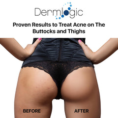 Dermlogic butt-thigh acne treatment creamy texture for easy spread