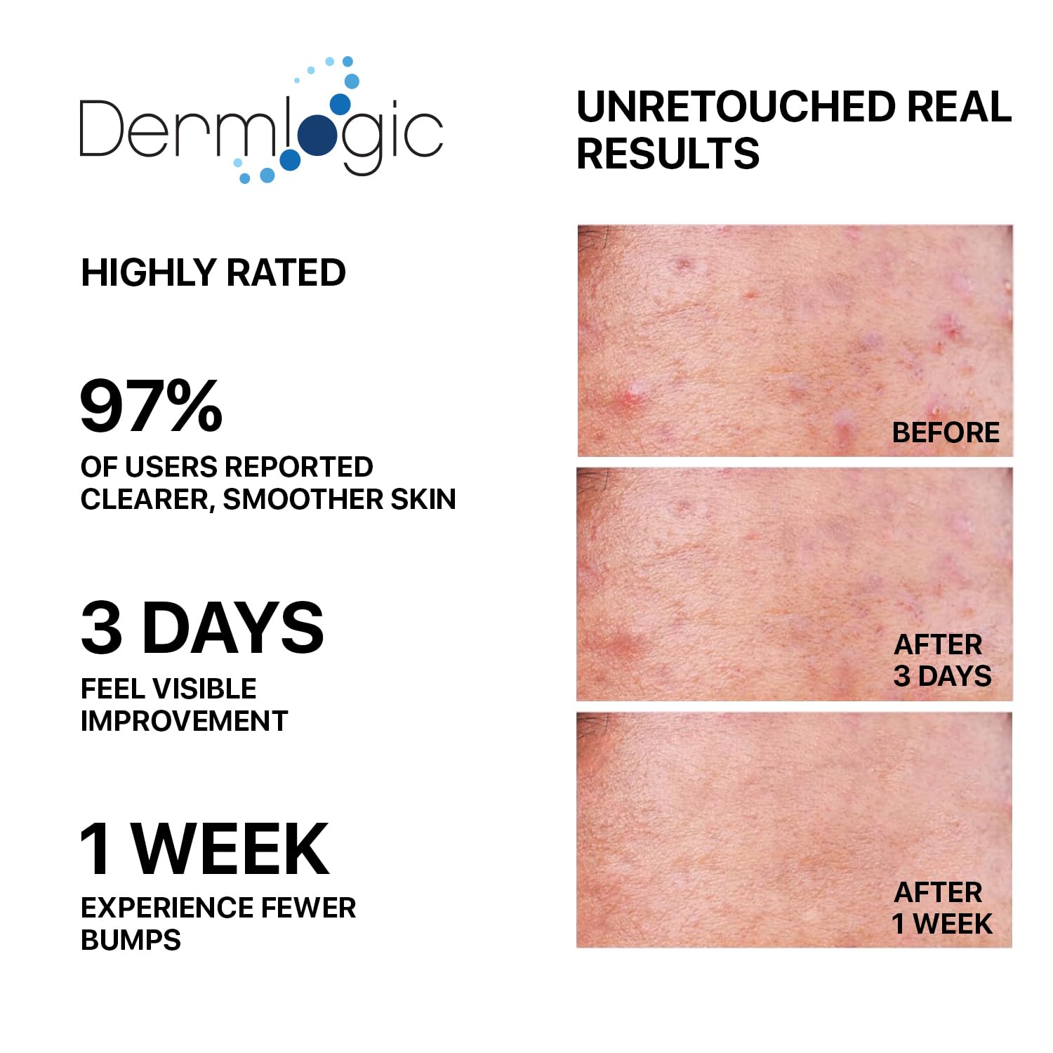 Dermlogic butt-thigh acne treatment on skin during daily routine