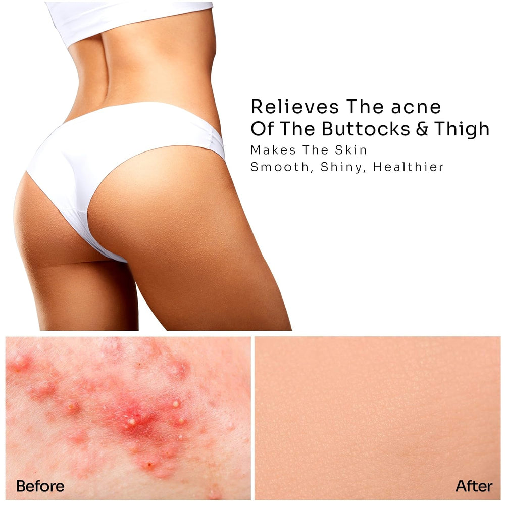 Dermlogic butt-thigh acne treatment pump dispenser for hygienic use