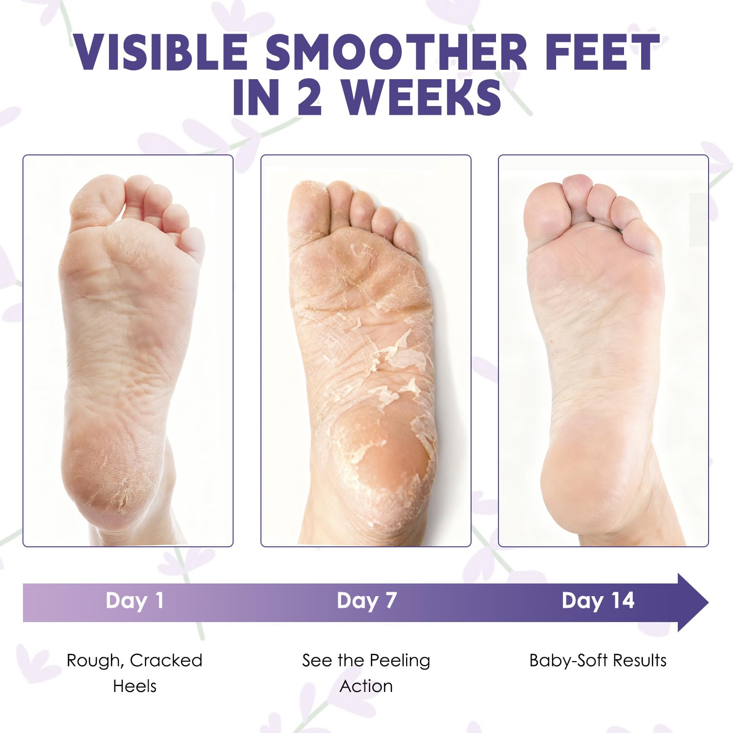Devyonder results show soft, smooth feet after treatment.