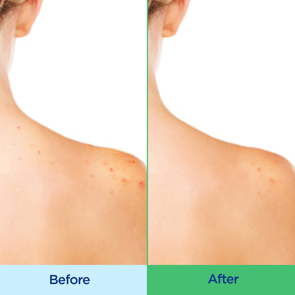 Differin 2% salicylic acid label highlighting pore clearing.
