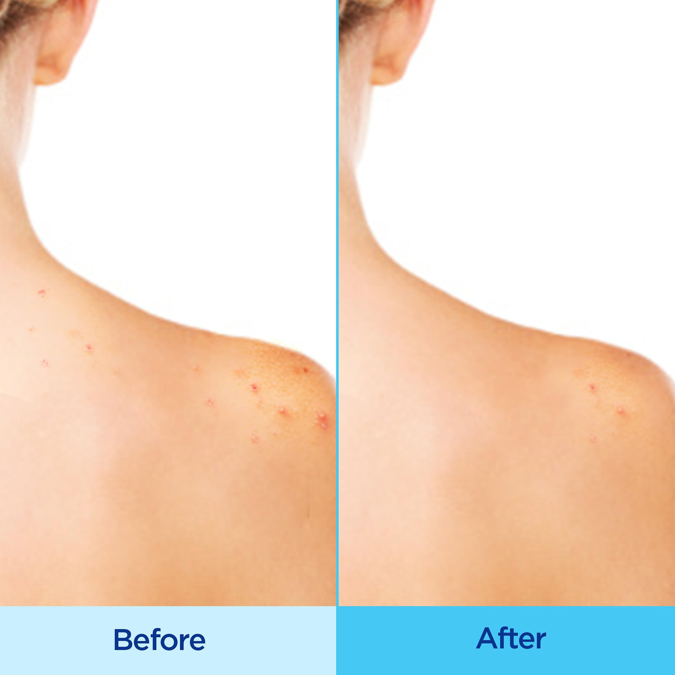 Differin Acne-Clearing Body Spray mist applied to the back for hard-to-reach areas