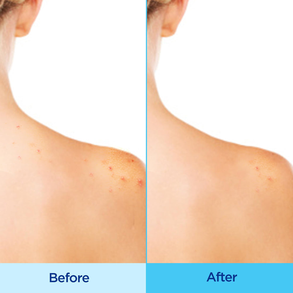 Differin Acne-Clearing Body Spray mist applied to the back for hard-to-reach areas
