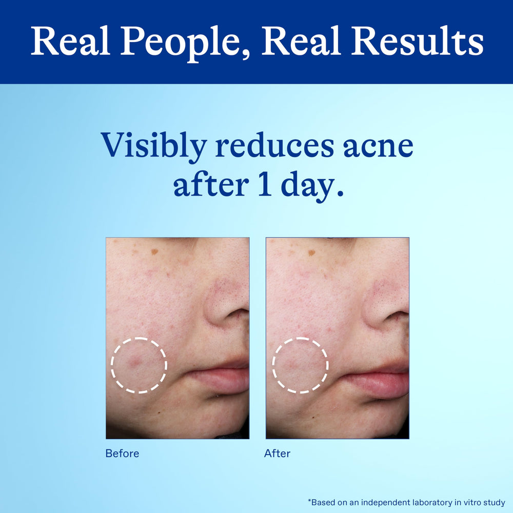 Differin skin care routine with moisturizer and SPF complements treatment.