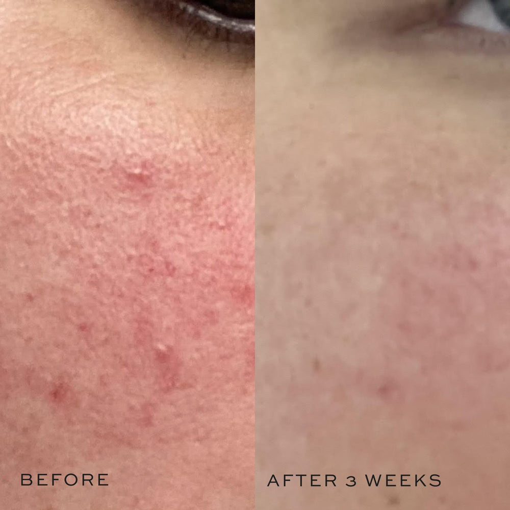 Witch hazel component in DIME toner for soothing care