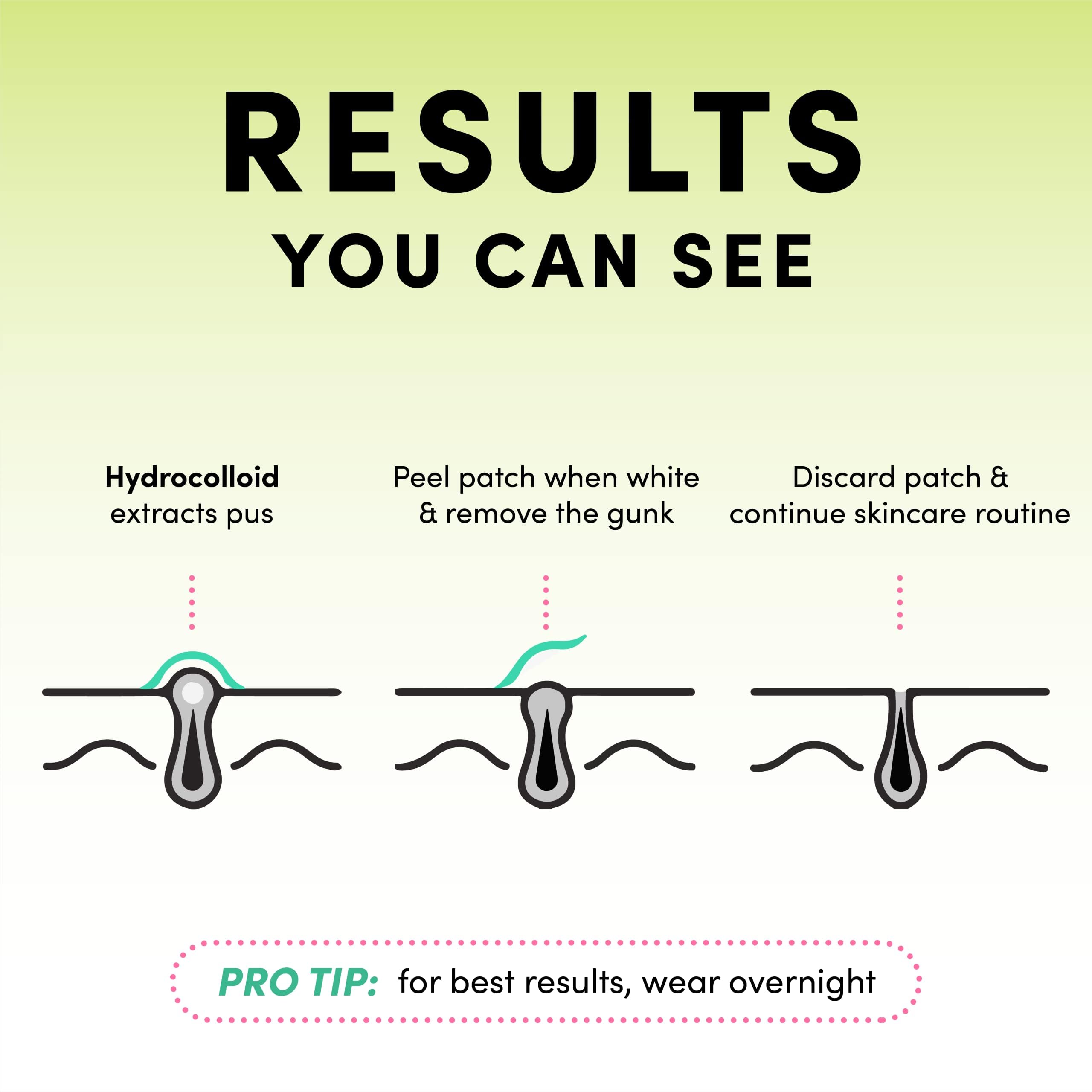 Dots for Spots patch applied at night provides a discreet, comfortable wear.