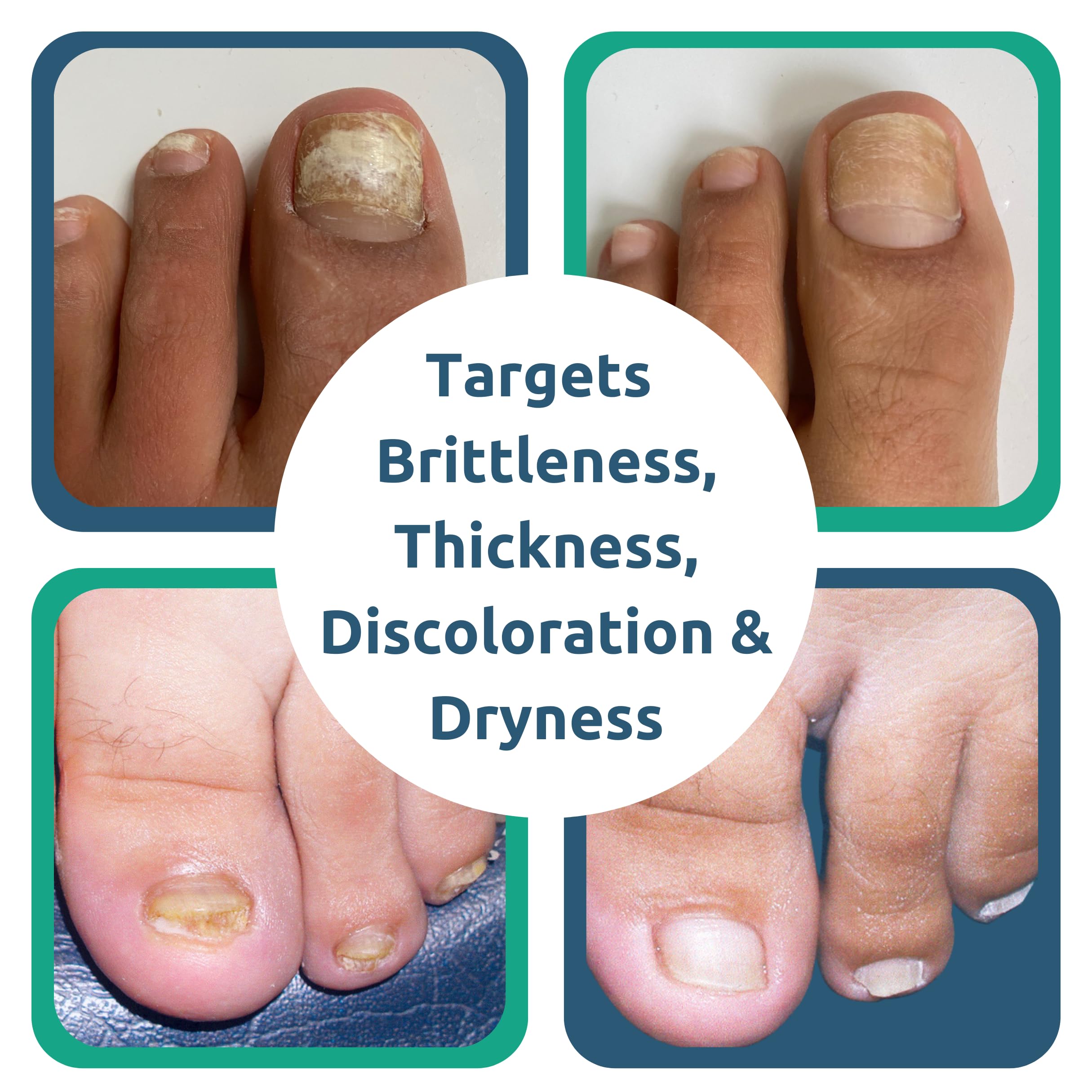 Dr. Blaine's Tineacide nails discoloration focus highlights lifted yellowing for a cleaner look.