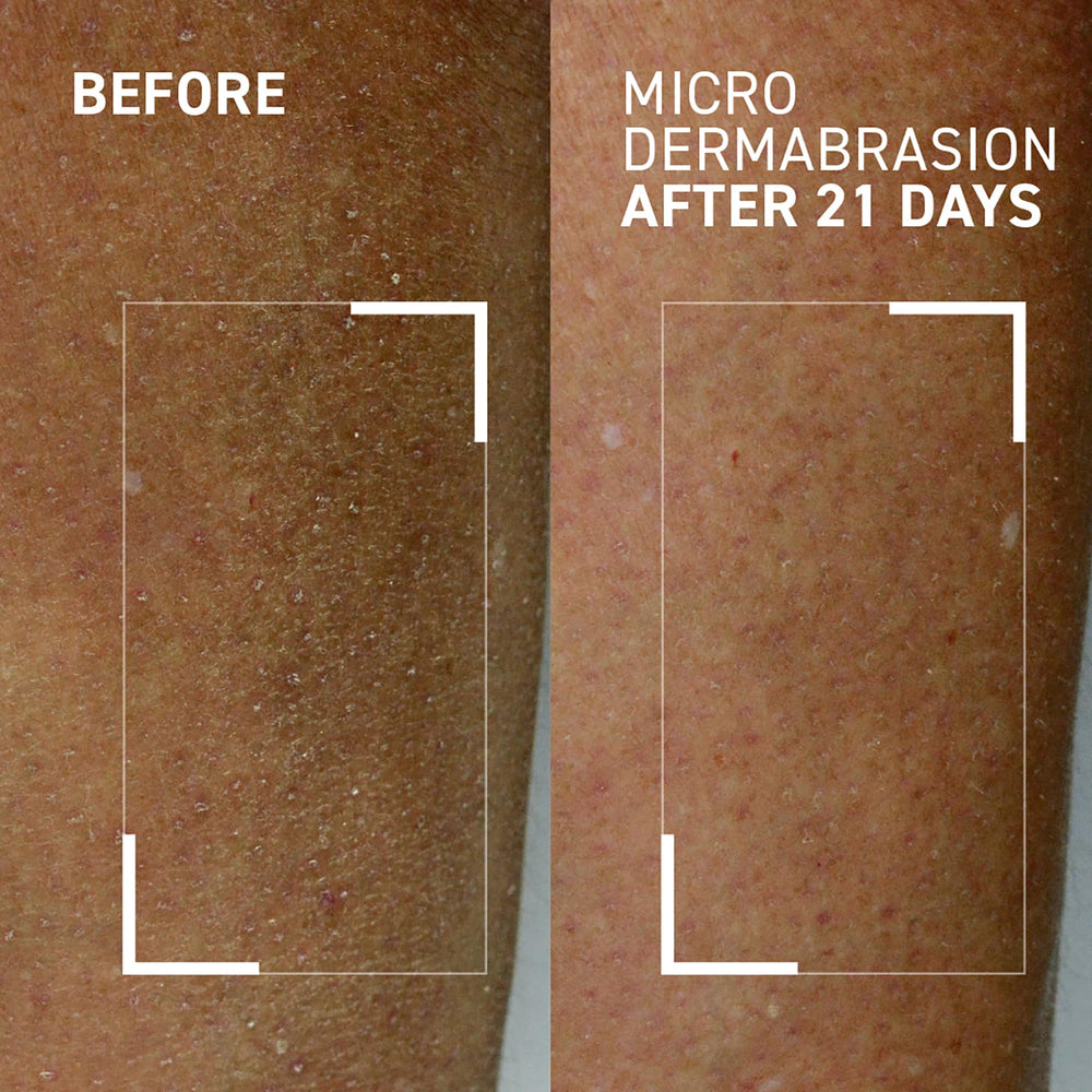 Dr. Brandt Skincare Microdermabrasion Hydrating Body Exfoliator on rough elbows and knees