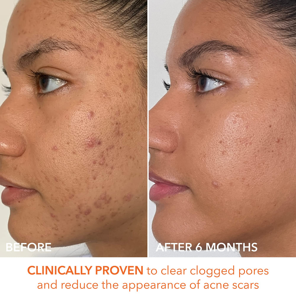 Close-up of skin texture after using the peel for comparison.