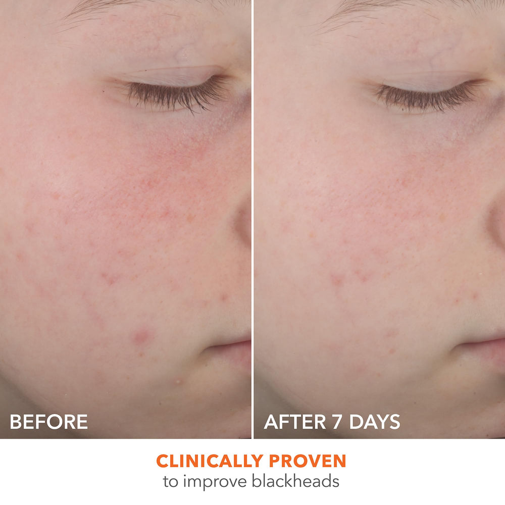 Ingredients label highlights 2% salicylic and glycolic acids for targeted blemish care.