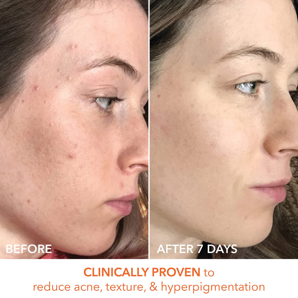 Before-and-after comparison hints at a smoother, more even complexion.