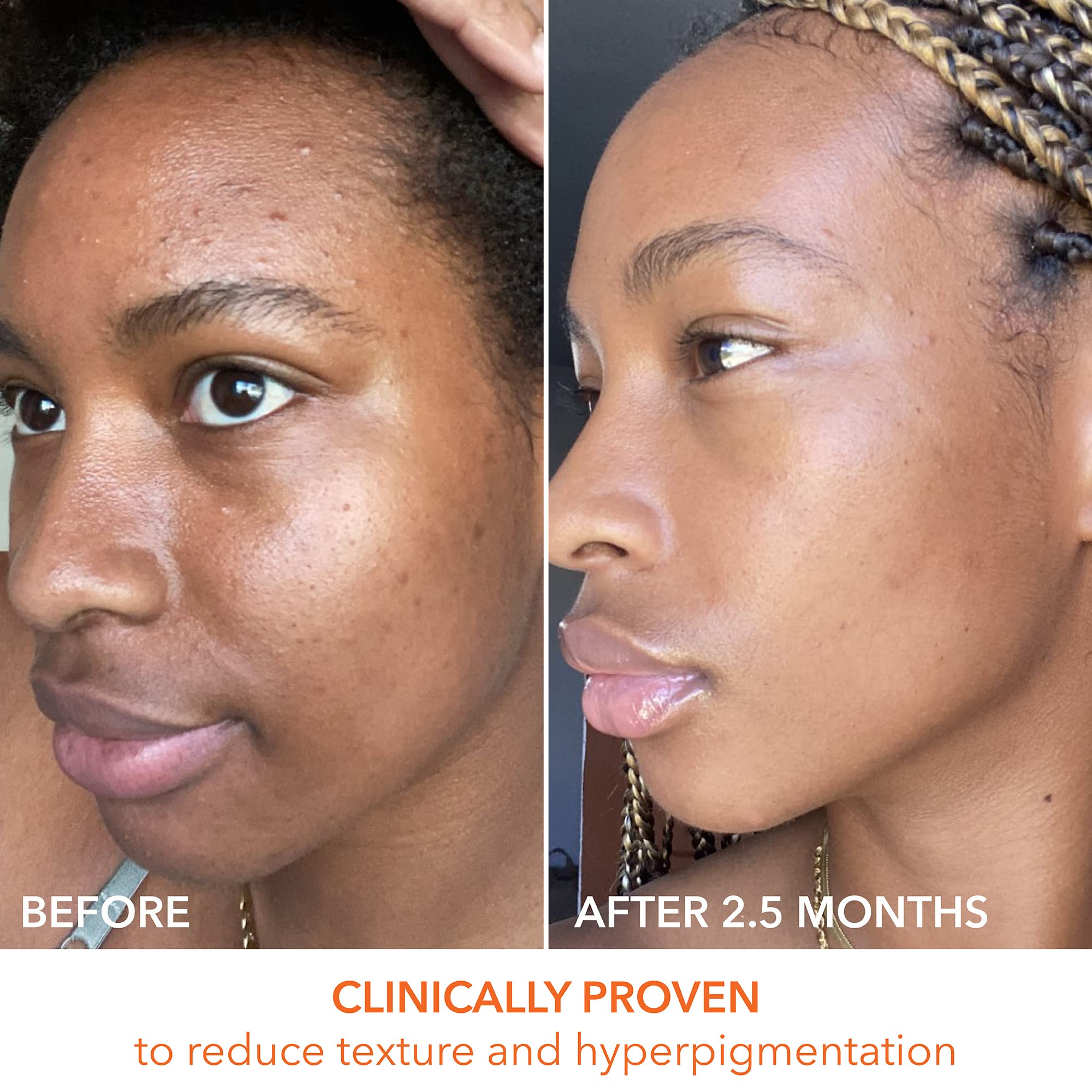 Pores look refined in a close-up view after treatment.