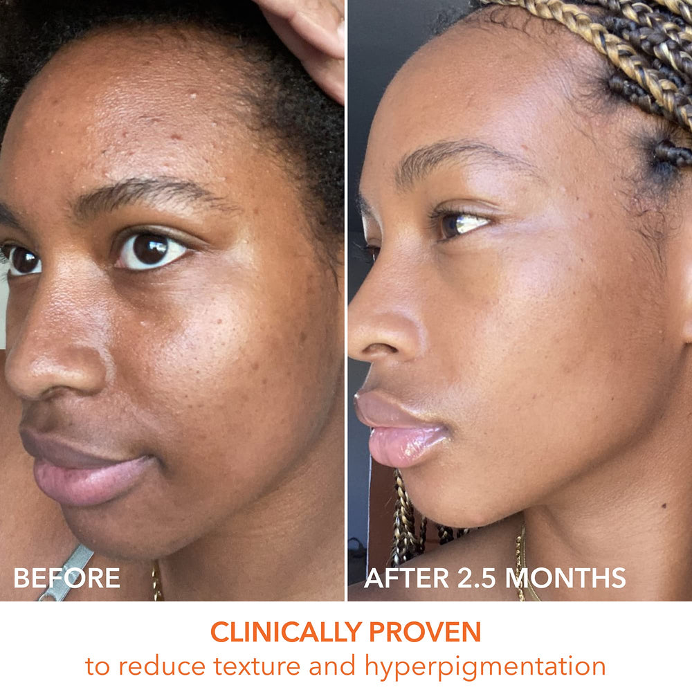 Pores look refined in a close-up view after treatment.