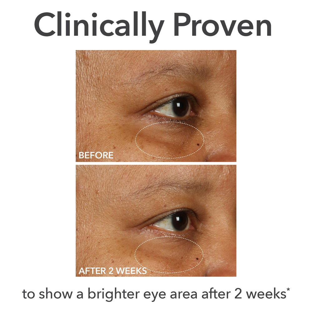 Under-eye area in focus with cream brightening and smoothing results