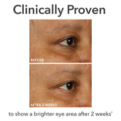 Under-eye area in focus with cream brightening and smoothing results