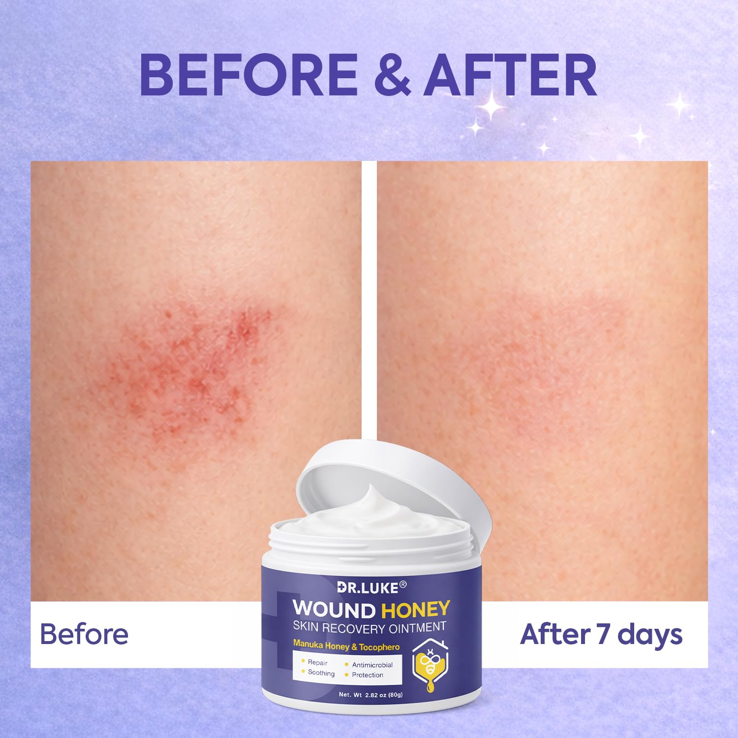 Dr. Luke Manuka Honey Wound Gel in use on skin for minor scrapes.